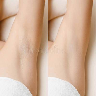 Body Permanent Hair Removal